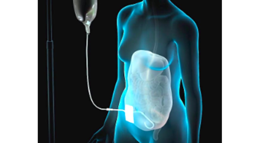 Colocación de catéter de diálisis peritoneal