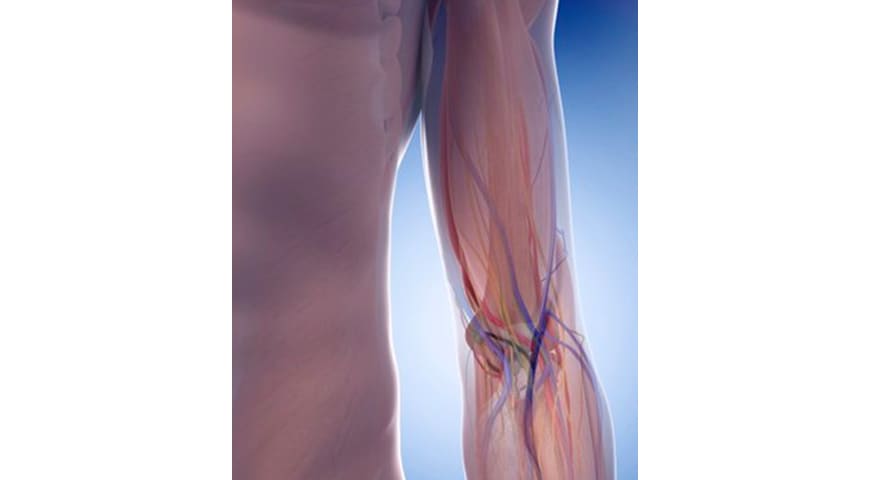 Fistulas arteriovenosas para hemodiálisis