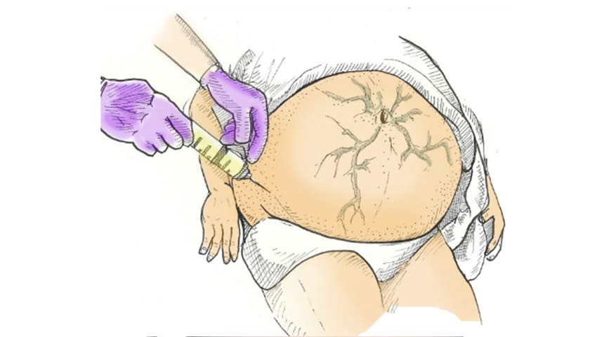 Paracentesis